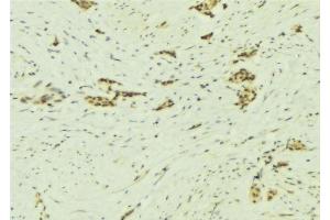 ABIN6277335 at 1/100 staining Human breast cancer tissue by IHC-P. (NAP1L1 抗体  (C-Term))