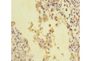 Immunohistochemistry of paraffin-embedded human lung cancer using ABIN7168626 at dilution of 1:100 (STIL 抗体  (AA 388-637))