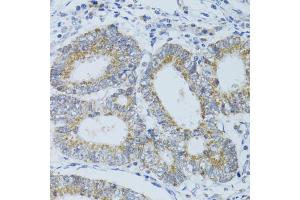 Immunohistochemistry of paraffin-embedded human colon carcinoma using DNAJC19 antibody. (DNAJC19 抗体)