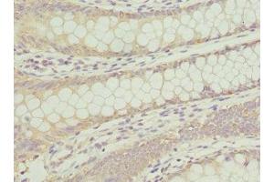 Immunohistochemistry of paraffin-embedded human colon cancer using ABIN7144072 at dilution of 1:100 (ANAPC2 抗体  (AA 1-230))