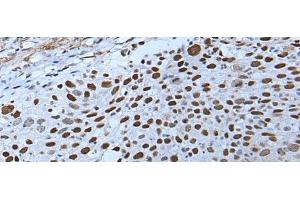 Immunohistochemistry of paraffin-embedded Human lung cancer tissue using ZNHIT3 Polyclonal Antibody at dilution of 1:80(x200) (ZNHIT3 抗体)