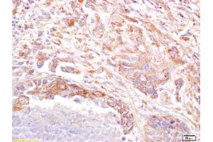 Formalin-fixed and paraffin embedded human lung carcinoma labeled with Anti PRSS8 Polyclonal Antibody (ABIN761891), Unconjugated at 1:200, followed by conjugation to the secondary antibody and DAB staining (PRSS8 抗体  (AA 65-165))