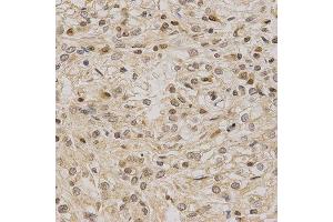Immunohistochemistry of paraffin-embedded human kidney cancer using LETMD1 antibody at dilution of 1:200 (x400 lens) (LETMD1 抗体  (AA 161-360))