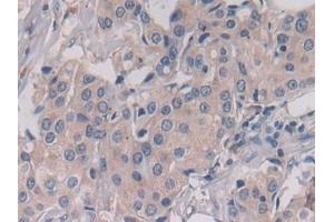 Detection of LGMN in Human Breast cancer Tissue using Polyclonal Antibody to Legumain (LGMN) (LGMN 抗体  (AA 18-433))