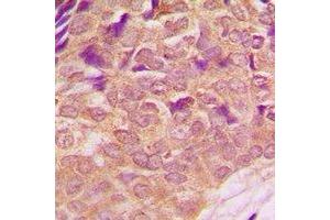 Immunohistochemical analysis of PI3K p85 alpha (pY607) staining in human breast cancer formalin fixed paraffin embedded tissue section.