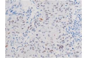 Immunohistochemistry (IHC) image for anti-Signal Transducer and Activator of Transcription 3 (Acute-Phase Response Factor) (STAT3) (pSer727) antibody (ABIN6256411)