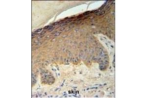 KRT35 Antibody (C-term) (ABIN651184 and ABIN2840116) IHC analysis in formalin fixed and paraffin embedded skin carcinoma followed by peroxidase conjugation of the secondary antibody and DAB staining. (Keratin 35 抗体  (C-Term))