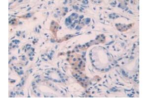 IHC-P analysis of Human Pancreas Cancer Tissue, with DAB staining. (IL10RB 抗体  (AA 87-243))