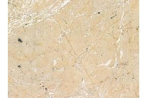 ABIN6260975 and ABIN6273213 at 1/100 staining human tongue carcinoma by IHC-P. (COQ9 抗体  (Internal Region))