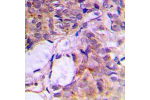 Immunohistochemical analysis of CNK2 staining in human breast cancer formalin fixed paraffin embedded tissue section.