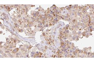 ABIN6277922 at 1/100 staining Human Melanoma tissue by IHC-P. (Cathelicidin 抗体  (Internal Region))