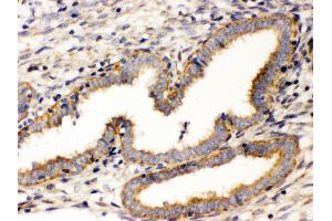 Anti- Wnt7a antibody, IHC(P) IHC(P): Human Endometrial Carcinoma Tissue
