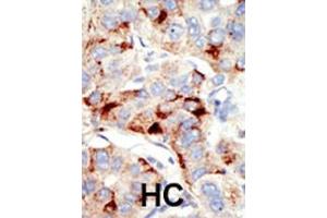 Formalin-fixed and paraffin-embedded human cancer tissue reacted with the primary antibody, which was peroxidase-conjugated to the secondary antibody, followed by DAB staining. (Dnmt2 抗体  (N-Term))