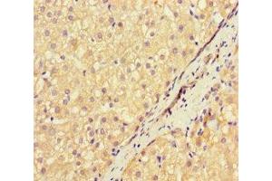 Immunohistochemistry of paraffin-embedded human liver cancer using ABIN7169570 at dilution of 1:100 (NEU1 抗体  (AA 201-415))