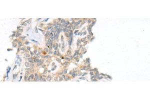 Immunohistochemistry of paraffin-embedded Human ovarian cancer tissue using CAMK2A Polyclonal Antibody at dilution of 1:55(x200) (CAMK2A 抗体)