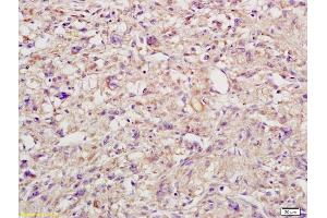 Formalin-fixed and paraffin embedded human endometrial cancer labeled with Anti-IL-6R Beta/CD130/gp130 Polyclonal Antibody, Unconjugated (ABIN686842) followed by conjugation to the secondary antibody and DAB staining