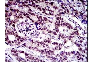Immunohistochemical analysis of paraffin-embedded esophageal cancer tissues using CFLAR mouse mAb with DAB staining. (FLIP 抗体  (AA 100-251))