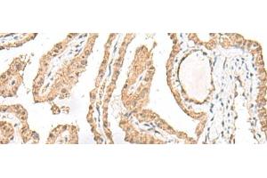 Immunohistochemistry of paraffin-embedded Human thyroid cancer tissue using RALGAPA1 Polyclonal Antibody at dilution of 1:55(x200) (GARNL1 抗体)
