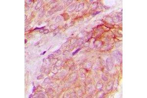 Immunohistochemical analysis of WASF1 (pY125) staining in human breast cancer formalin fixed paraffin embedded tissue section. (WASF1 抗体  (pTyr125))