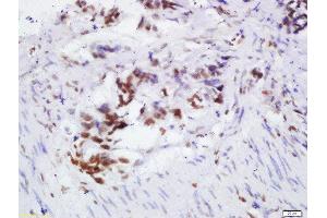 Formalin-fixed and paraffin embedded human colon cancer labeled with Rabbit Anti-OGG1 Polyclonal Antibody, Unconjugated 1:200 followed by conjugation to the secondary antibody and DAB staining (OGG1 抗体  (AA 151-250))