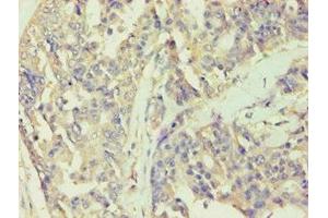Immunohistochemistry of paraffin-embedded human endometrial cancer using ABIN7141988 at dilution of 1:100 (BCKDK 抗体  (AA 153-412))