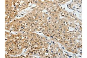 The image on the left is immunohistochemistry of paraffin-embedded Human lung cancer tissue using ABIN7193012(VEGFA Antibody) at dilution 1/25, on the right is treated with synthetic peptide.