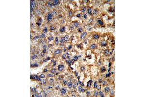 Formalin-fixed and paraffin-embedded human hepatocarcinoma reacted with HSD17B12 Antibody (Center), which was peroxidase-conjugated to the secondary antibody, followed by DAB staining.