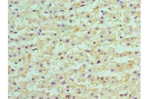 Immunohistochemistry of paraffin-embedded human liver cancer using ABIN7145594 at dilution of 1:100 (SULT2A1 抗体  (AA 1-145))