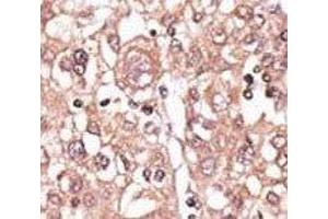 IHC analysis of FFPE human hepatocarcinoma tissue stained with the anti-TLR7 antibody (TLR7 抗体  (AA 98-128))