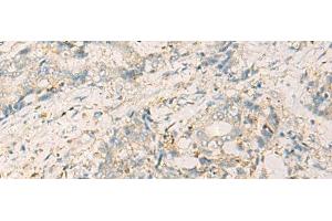 Immunohistochemistry of paraffin-embedded Human cervical cancer tissue using WDR37 Polyclonal Antibody at dilution of 1:50(x200) (WDR37 抗体)