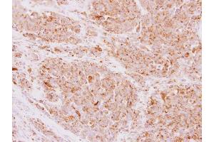 IHC-P Image NDUFS5 antibody detects NDUFS5 protein at mitochondria on human lung adenocarcinoma by immunohistochemical analysis.