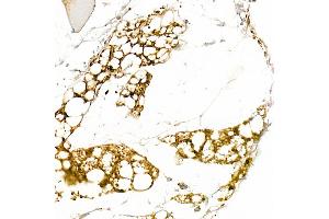 Immunohistochemistry of paraffin-embedded human liver using [KO Validated] Cytokeratin 8 Rabbit pAb (ABIN3021287, ABIN3021288, ABIN3021289, ABIN1513142 and ABIN1514287) at dilution of 1:50 (40x lens). (KRT8 抗体  (AA 1-483))