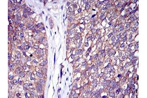 Immunohistochemical analysis of paraffin-embedded bladder cancer tissues using C-CBL mouse mAb with DAB staining. (CBL 抗体)