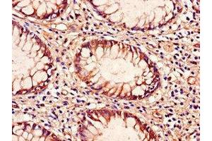 Immunohistochemistry of paraffin-embedded human colon cancer using ABIN7172286 at dilution of 1:100 (TLR9 抗体  (AA 425-563))