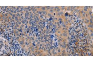 Immunohistochemistry of paraffin-embedded Human cervical cancer tissue using MAP3K13 Polyclonal Antibody at dilution 1:40 (MAP3K13 抗体)