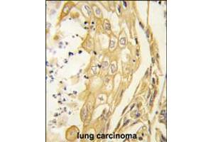 Formalin-fixed and paraffin-embedded human lung carcinoma tissue reacted with the EphB4 antibody , which was peroxidase-conjugated to the secondary antibody, followed by DAB staining. (EPH Receptor B4 抗体)