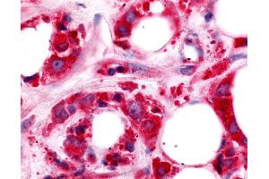 Anti-HUNK / B19 antibody IHC of human Breast, Carcinoma. (HUNK 抗体  (Kinase Domain))