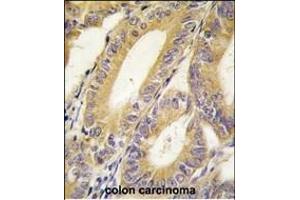 Formalin-fixed and paraffin-embedded human colon carcinoma tissue reacted with BIRC4 antibody (N-term) (ABIN390070 and ABIN2840594) , which was peroxidase-conjugated to the secondary antibody, followed by DAB staining. (XIAP 抗体  (N-Term))