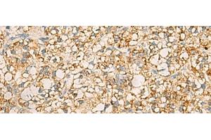 Immunohistochemistry of paraffin-embedded Human liver cancer tissue using PDCL Polyclonal Antibody at dilution of 1:40(x200) (Phosducin-Like 抗体)