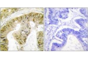 Immunohistochemistry analysis of paraffin-embedded human colon carcinoma, using FANCA (Phospho-Ser1149) Antibody. (FANCA 抗体  (pSer1149))
