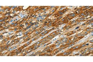 Immunohistochemistry of paraffin-embedded Human esophagus cancer using CAV1 Polyclonal Antibody at dilution of 1:40 (Caveolin-1 抗体)