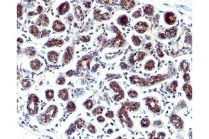 IHC staining of human breast cancer with Estrogen Inducible Protein pS2 antibody. (TFF1 抗体  (C-Term))