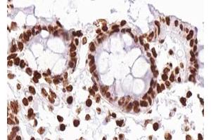 ABIN6267280 at 1/100 staining human Colon carcinoma tissue sections by IHC-P. (RAF1 抗体  (pSer296))