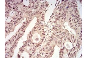 Immunohistochemical analysis of paraffin-embedded rectum cancer tissues using YWHAB mouse mAb with DAB staining.