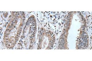 Immunohistochemistry of paraffin-embedded Human liver cancer tissue using UBA52 Polyclonal Antibody at dilution of 1:55(x200) (UBA52 抗体)