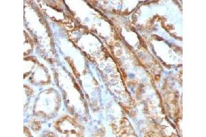 IHC testing of FFPE human renal cell carcinoma with Mitochondrial antibody (GFM1 抗体)