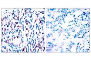 Immunohistochemical analysis of paraffin-embedded human breast carcinoma tissue using STAT3 (phospho-Tyr705) antibody (E011045). (STAT3 抗体  (pTyr705))