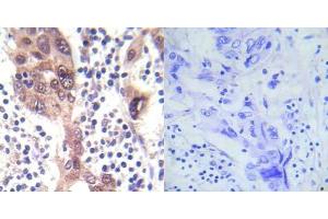 Immunohistochemical analysis of paraffin-embedded human breast carcinoma tissue using LKB1 (phospho- Ser428) antibody (E012046). (LKB1 抗体  (pSer428))