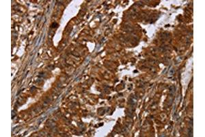The image on the left is immunohistochemistry of paraffin-embedded Human esophagus cancer tissue using ABIN7191964(POU6F2 Antibody) at dilution 1/30, on the right is treated with synthetic peptide. (POU6F2 抗体)
