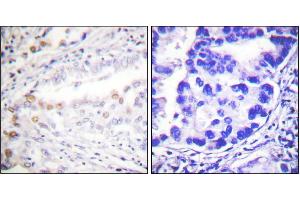 Immunohistochemistry analysis of paraffin-embedded human lung carcinoma tissue using Uba2 antibody. (UBA2 抗体)